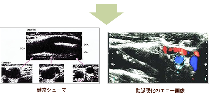 健常シェマー　動脈硬化のエコー画像
