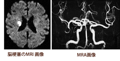 脳梗塞のＭＲＩ画像　ＭＲＡ画像